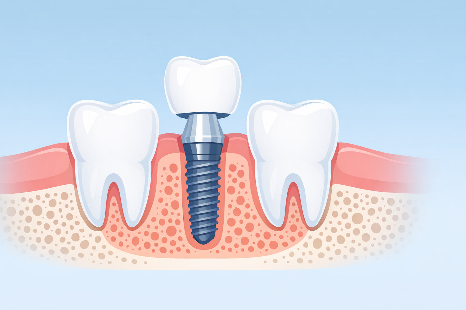 Implant dentar: Ghid complet despre procedură, preț, durată și recuperare