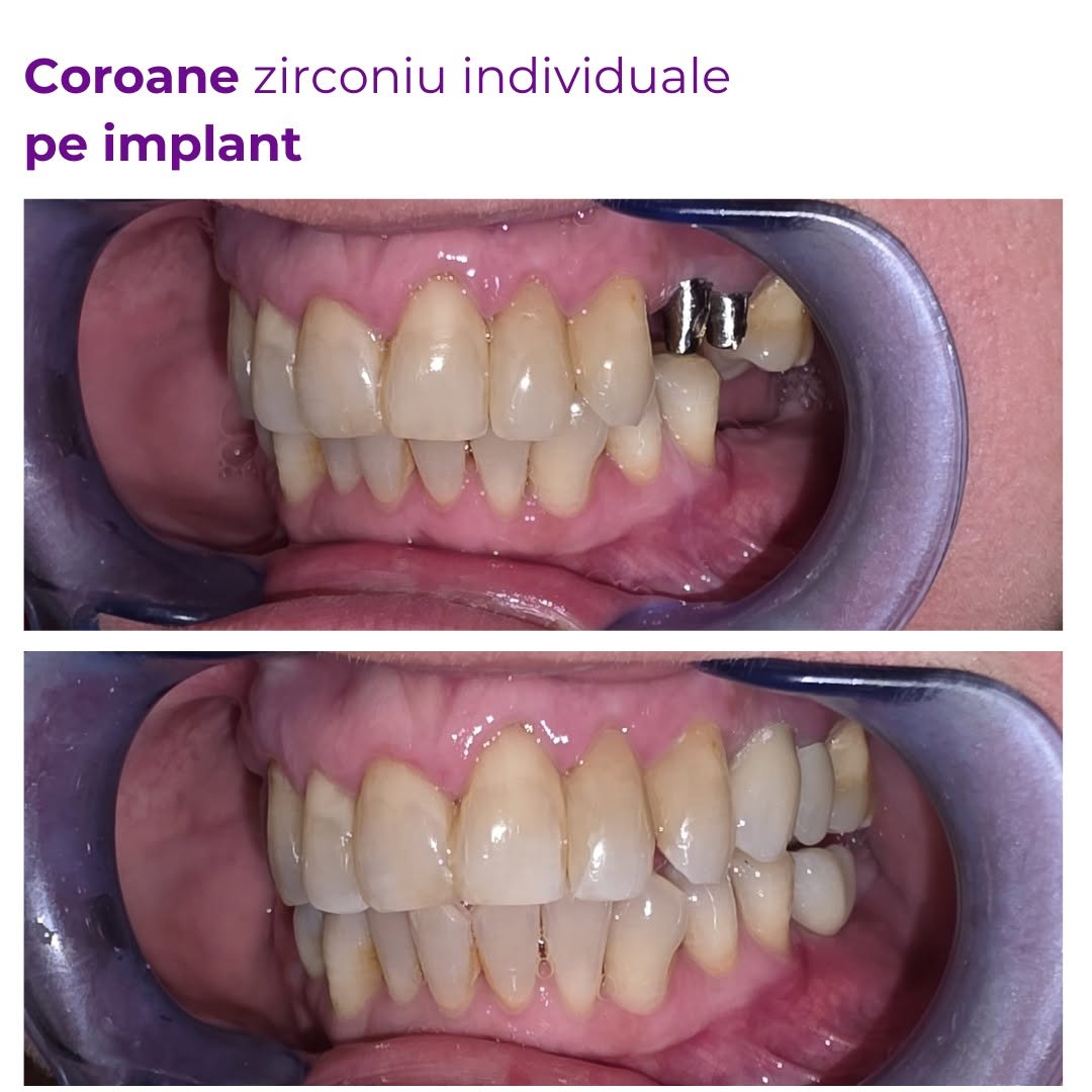 Smile Implant - fotografie 2