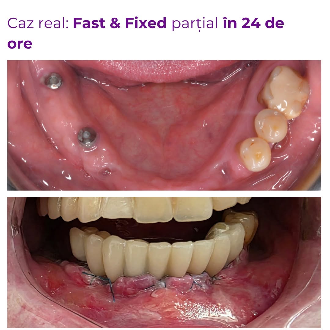 Smile Implant - fotografie 3