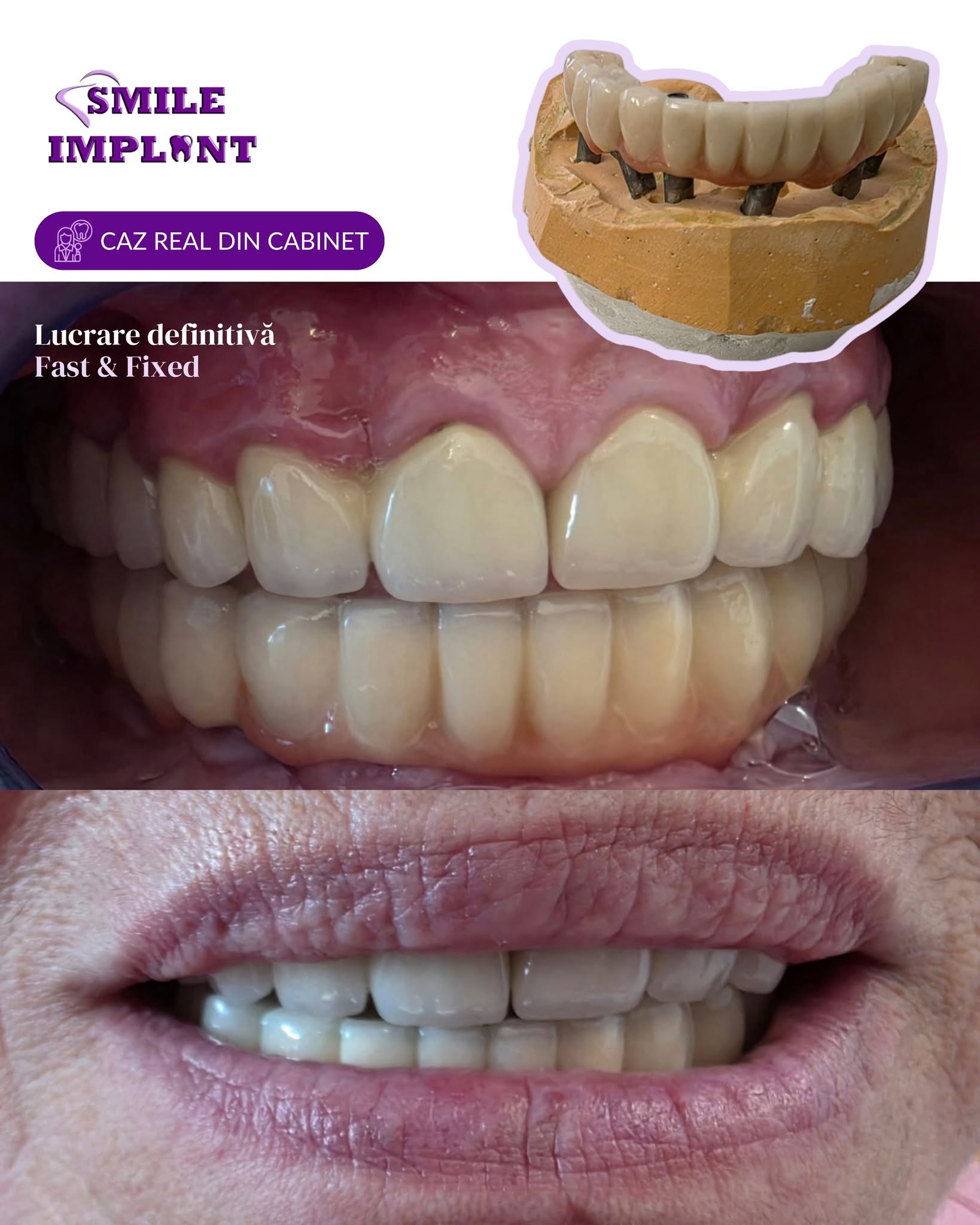 Smile Implant